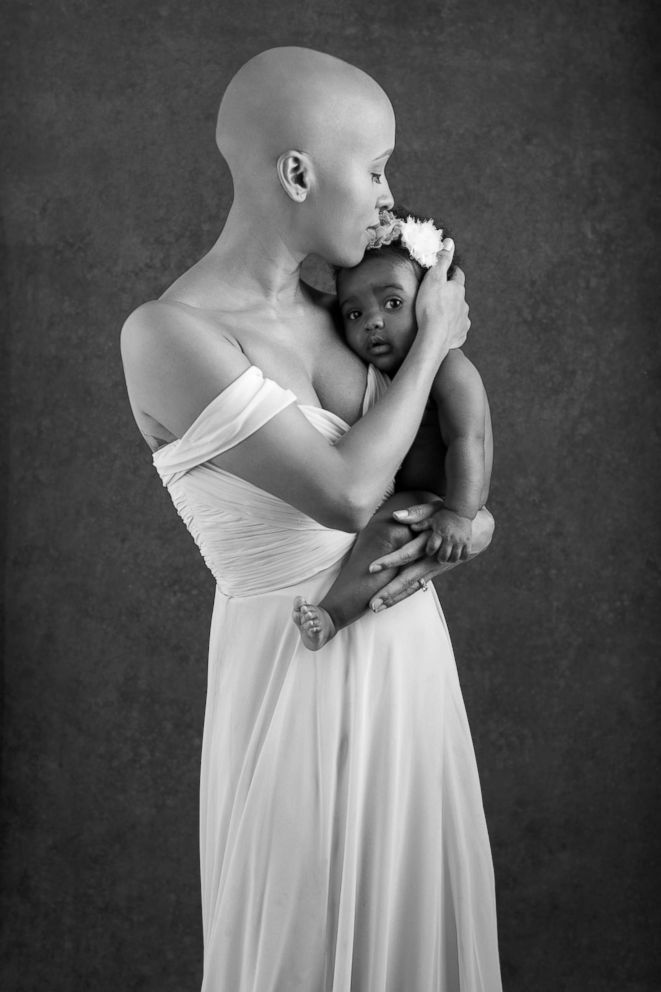 PHOTO: Courtni Guevara, who was diagnosed with alopecia last year, poses with her daughter, Zuri, in a photo shoot.