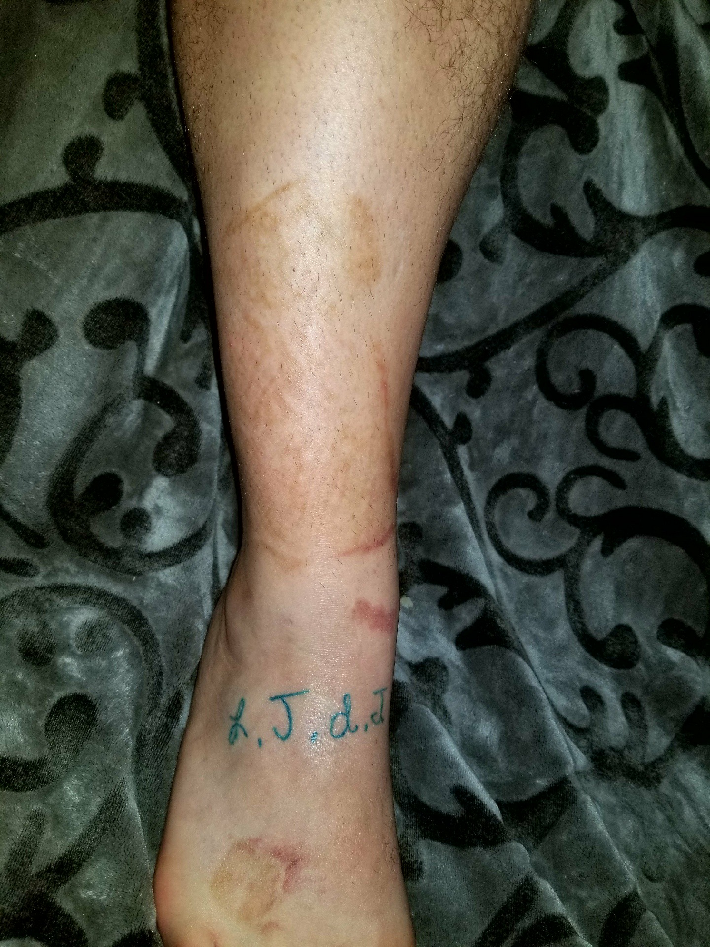 PHOTO: Joel Thomas, 31, of Festus, Missouri, received a tattoo replica of his son's burn scars after an accident from May 2016 left his son Landon, 9, with burn scars on his right leg and foot. 