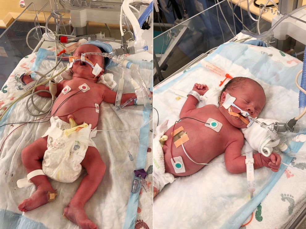 PHOTO: Eli Curran, left, and Aiden Curran, right, are treated in the neo-natal intensive care unit at UPMC Magee-Womens Hospital.