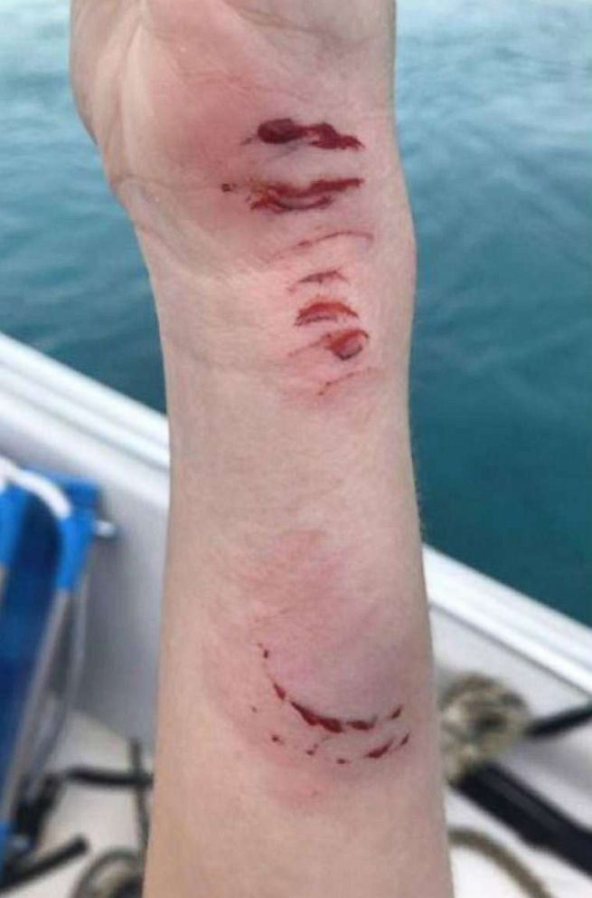 PHOTO: Sarah Carroll with her arm bandaged where she was bitten by a shark.