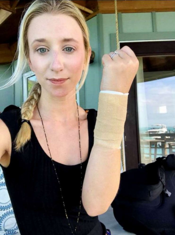 PHOTO: Sarah Carroll with her arm bandaged where she was bitten by a shark.