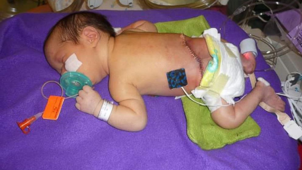PHOTO:Mayli Gibson was born paralyzed as a result of spina bifida.. 