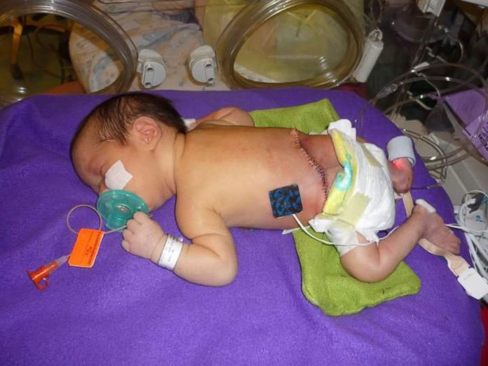 PHOTO:Mayli Gibson was born paralyzed as a result of spina bifida.. 