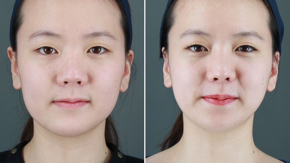 asian face surgery