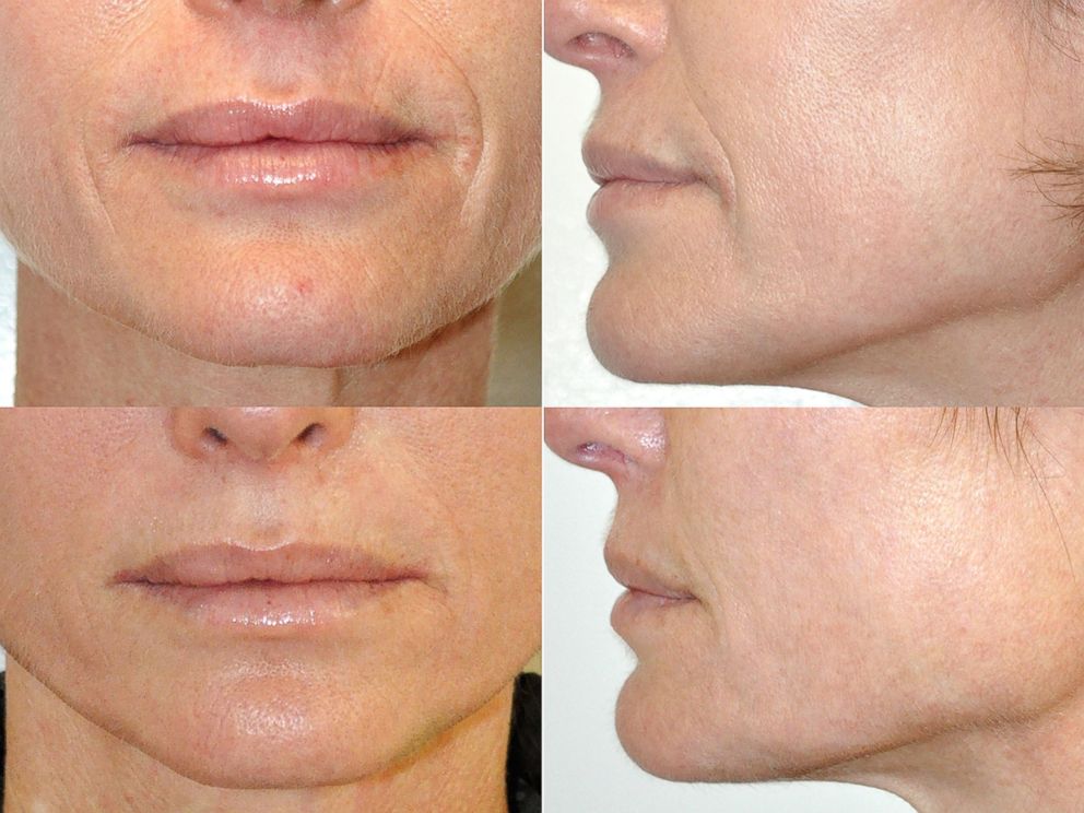 Skin Tightening  South Florida Facial Plastic Surgery