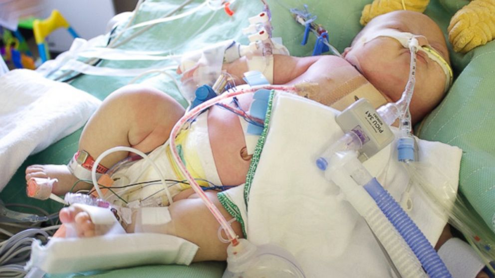 PHOTO: Jaxson had open heart surgery when he was 11 weeks old. 