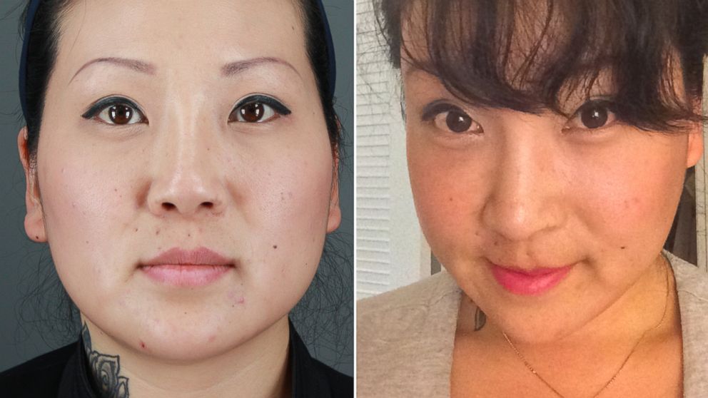 PHOTO: Jessica Choi, 33, before and after her facial plastic surgery procedures.