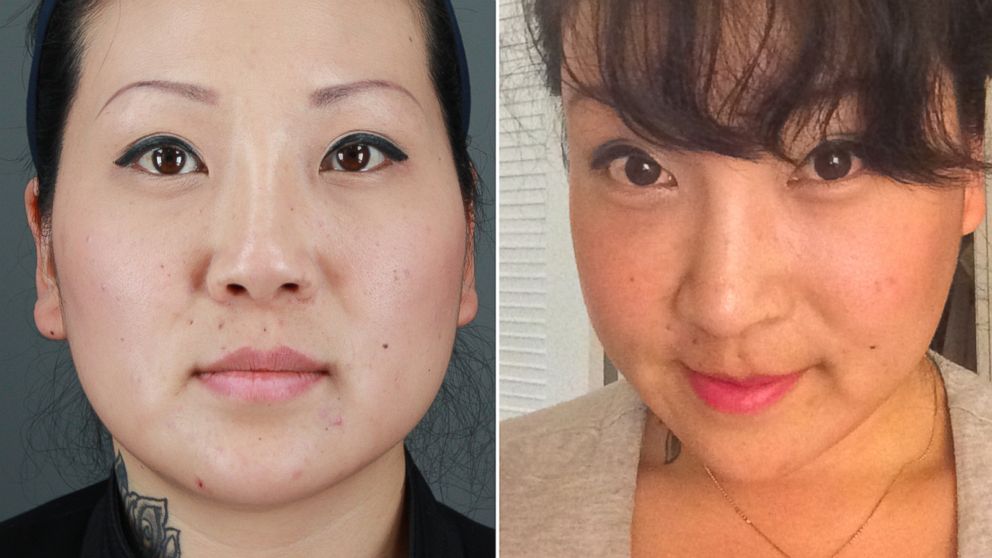 asian women plastic surgery