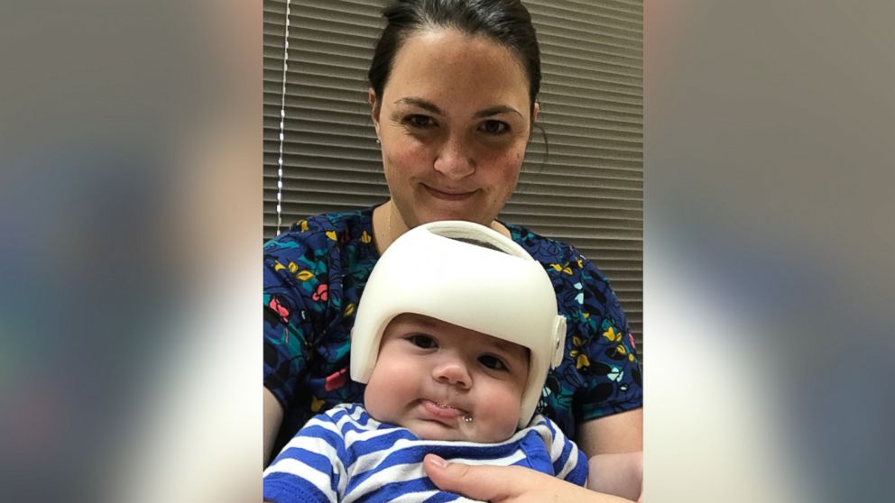 PHOTO: Mother of two Shayna Gutierrez with her 4-month-old Jonas Gutierrez, who was diagnosed with plagiocephaly in July.