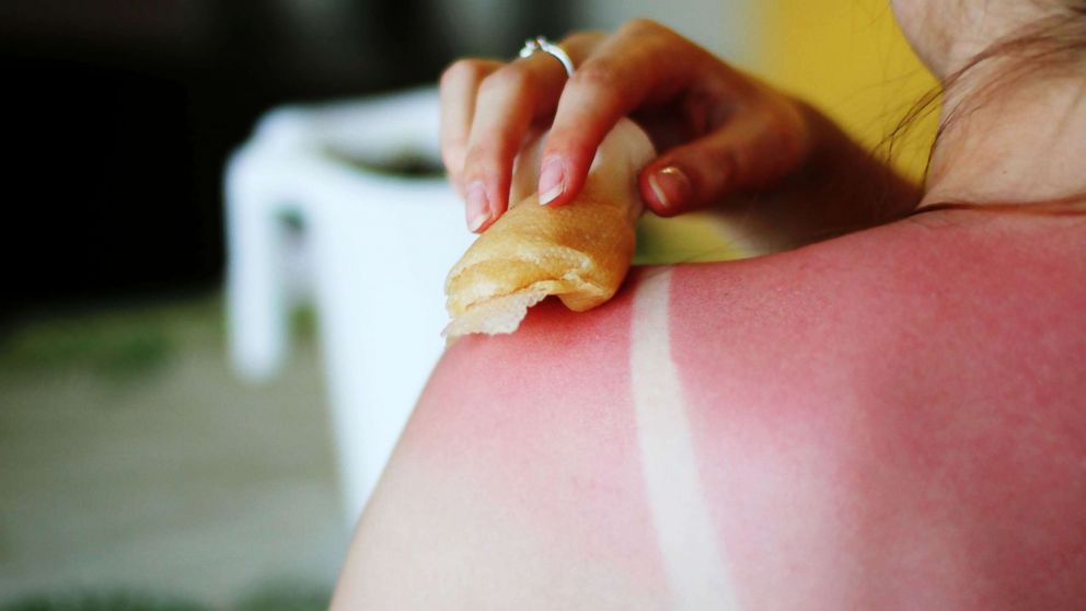 PHOTO: In this undated stock photo, a woman uses natural home remedies to treat sunburn.