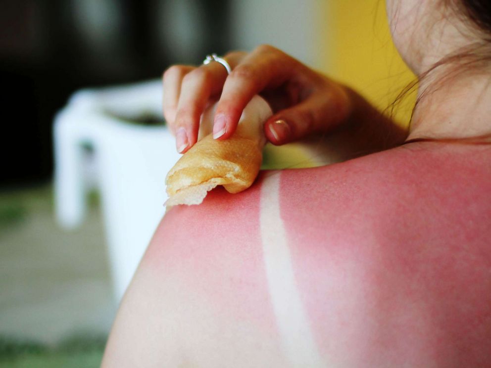 PHOTO: In this undated stock photo, a woman uses natural home remedies to treat sunburn.