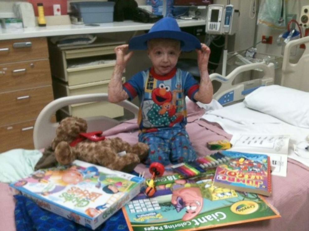 PHOTO: Owen Mahan, 10, suffered burns over 98 percent of his body at the age of 2.