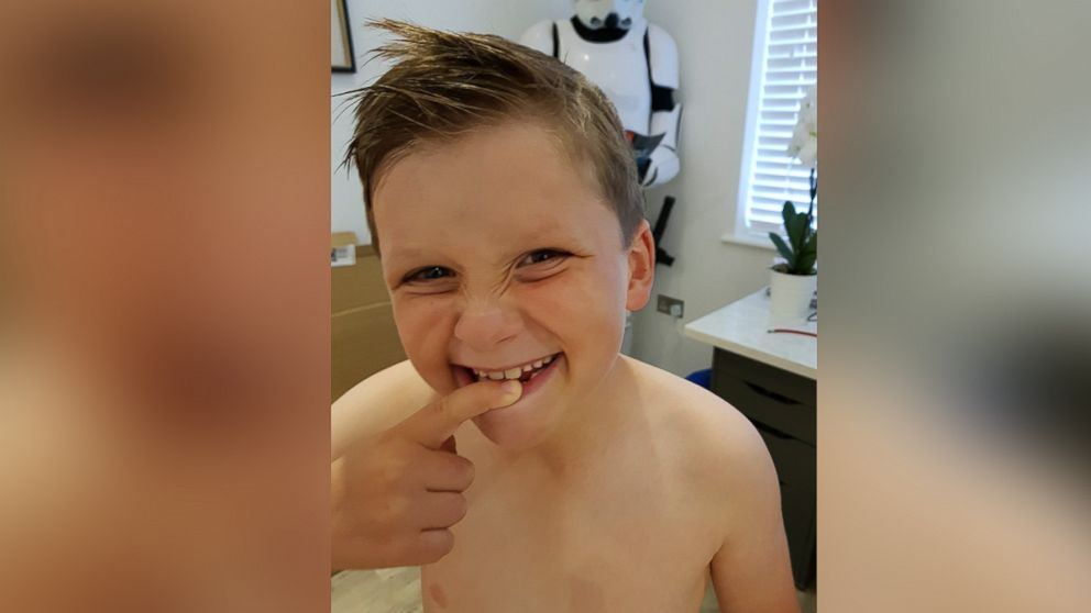 Sam Warren, 8, shows off his missing tooth.
