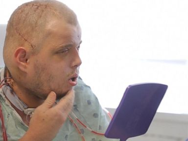 VIDEO: Face Transplant Patient Sees Himself for the First Time Post-Surgery