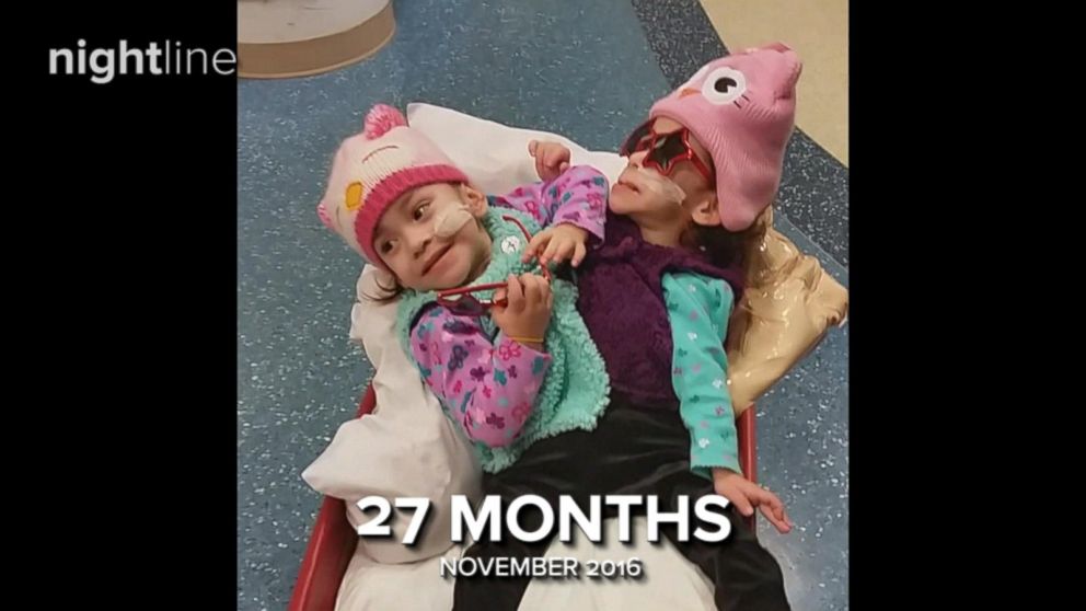 Formerly Conjoined Twins Before And After Separation Surgery Video Abc News