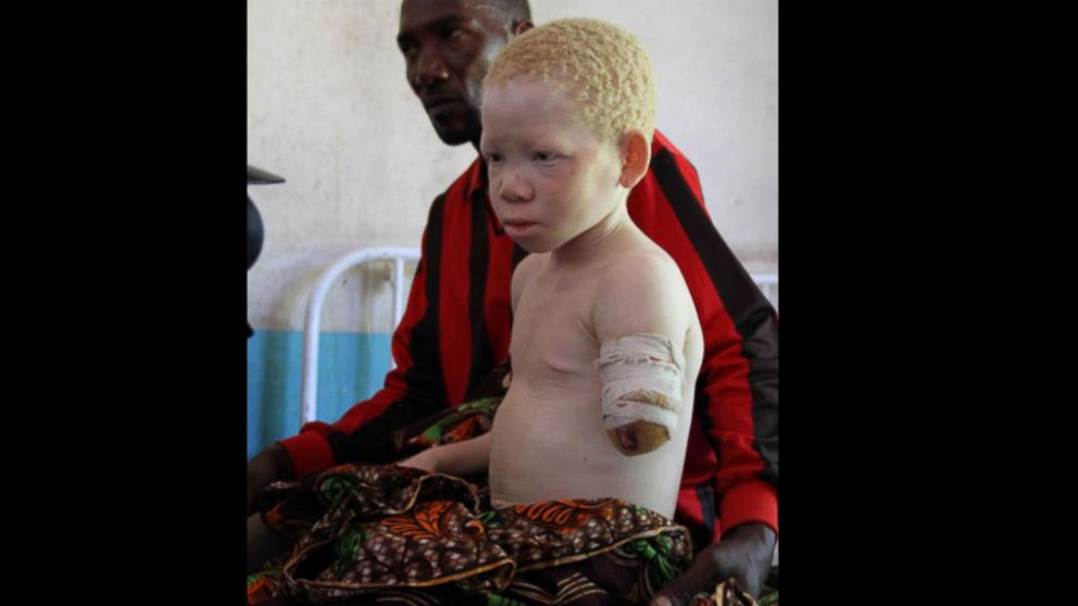 albino african