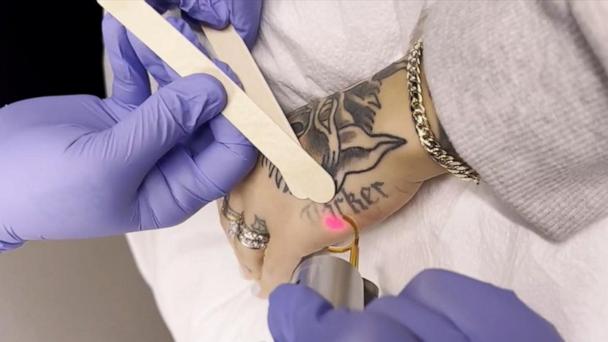 Tattoos are no longer permanent