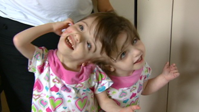 Conjoined Twins A Medical Wonder Video Abc News