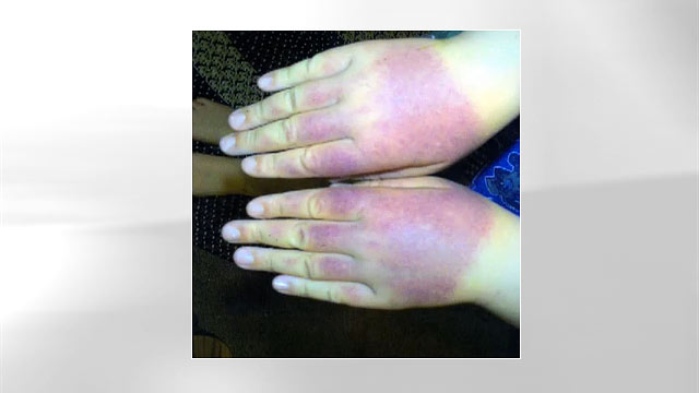 Sunlight Allergy Like Pouring Hot Wax On Your Skin Abc News Photo Nbsp After Removing His Protective Clothing While Waiting In Line For A Rollercoaster