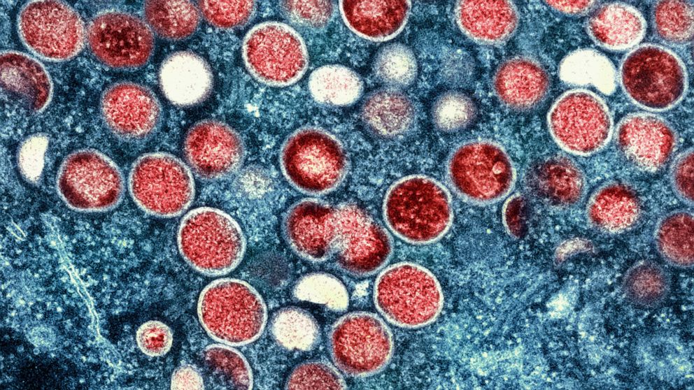 FILE - This image provided by the National Institute of Allergy and Infectious Diseases (NIAID) shows a colorized transmission electron micrograph of monkeypox particles (red) found within an infected cell (blue), cultured in the laboratory that was 