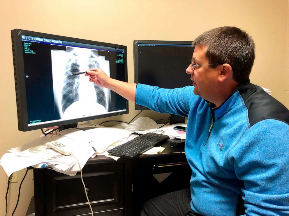 PHOTO: Dr. Brandon Crum points to the X-ray of a black lung patient at his office in Pikeville, Ky., Jan. 24, 2019. 