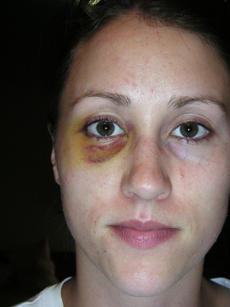 PHOTO: Colbie Holderness released this photo showing a black and blue eye. She claims Rob Porter punched her in the face more than a decade ago.