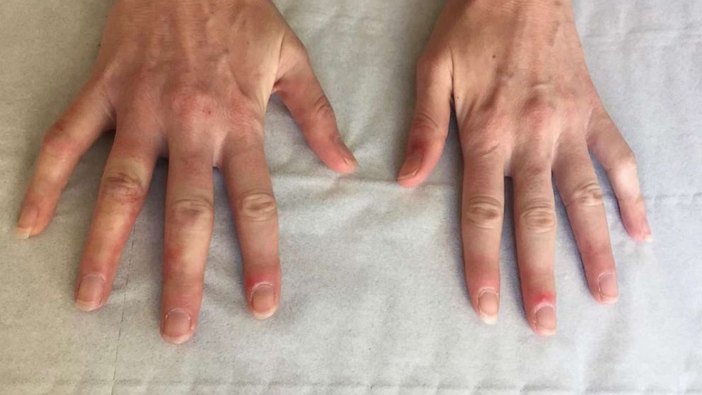 PHOTO: The skin findings that have been raising questions among dermatologists, appear on hands as well. 