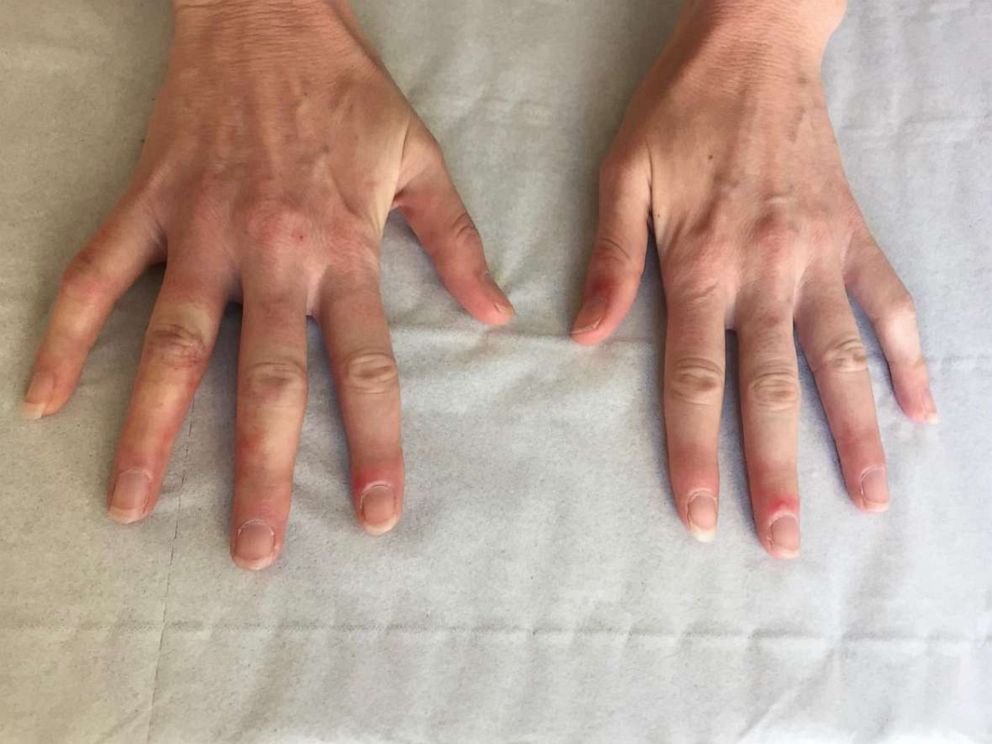 PHOTO: The skin findings that have been raising questions among dermatologists, appear on hands as well. 