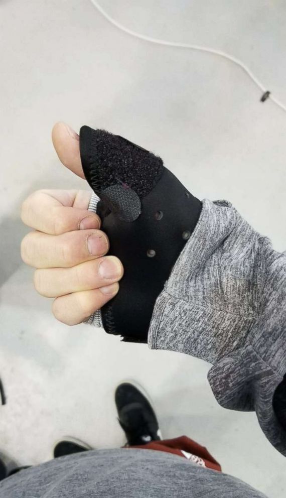 PHOTO: U.S. Winter Olympian Gus Kenworthy tweeted this photo of his broken thumb on Feb. 15, 2018.