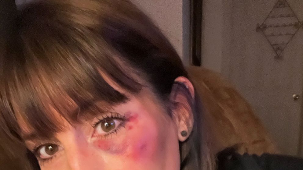 In this 2022 image released by Kristi Moore, Moore poses for a self portrait showing her bruised left eye, in Miss. On a play at second base, Moore called the runner safe. A woman watching the game thought the runner was out. She began screaming prof
