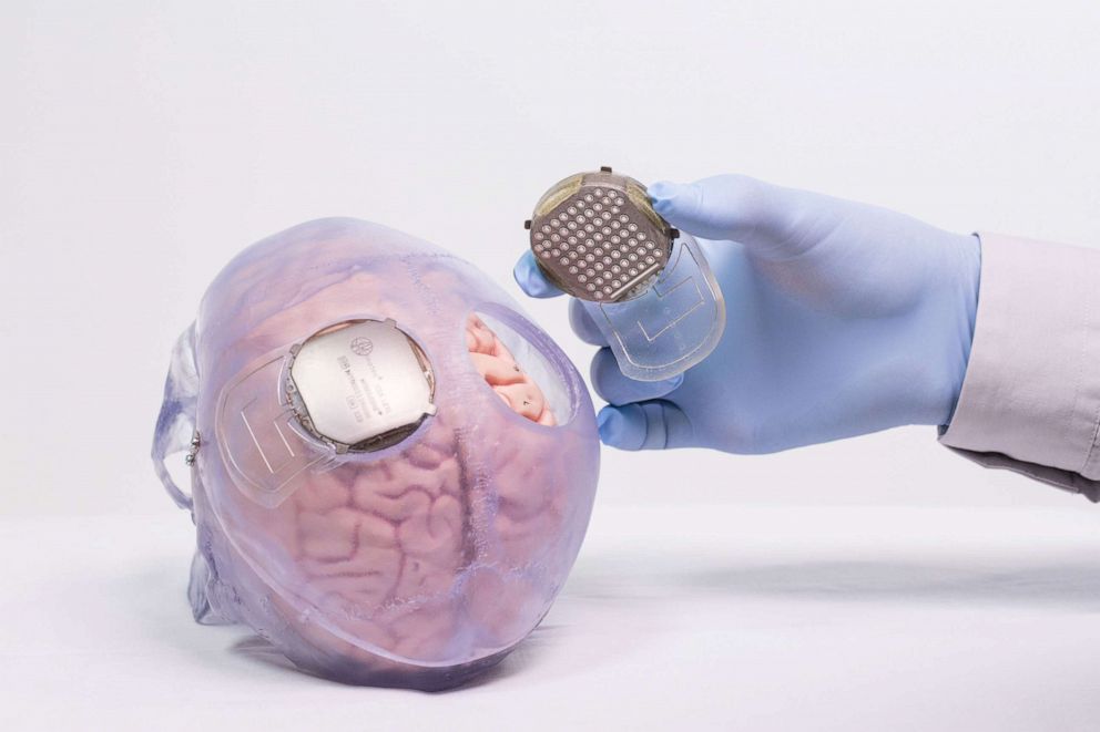 PHOTO: Electrodes on implants read brain activity and beam the instructions to a nearby computer.