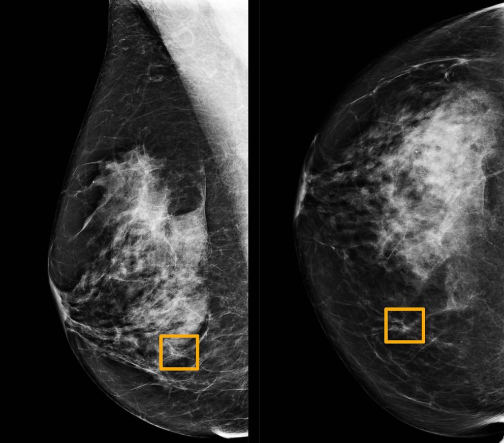 PHOTO: A yellow box indicates where an artificial intelligence (AI) system found cancer hiding inside breast tissue, in an undated photo released by Northwestern University in Chicago, Jan. 1, 2020. 