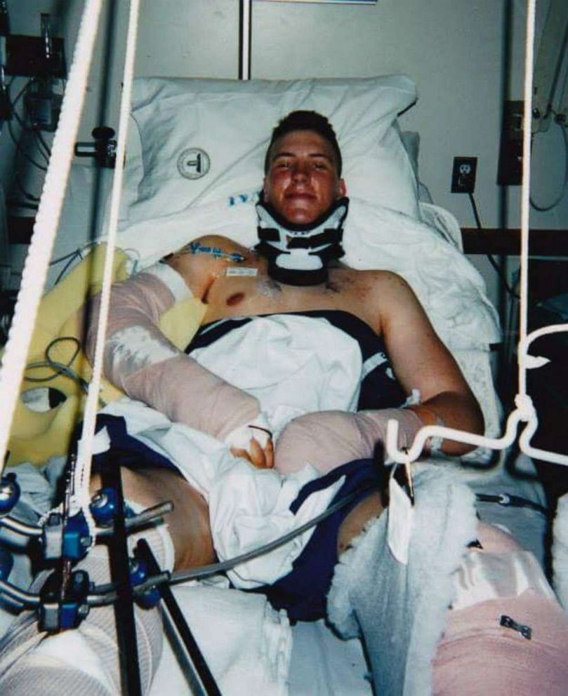 PHOTO: Daniel "Doc" Jacobs lost his left leg below the knee, three toes from his right foot, and three partial fingers from his left hand after an IED struck the truck he was in, in 2006 in Iraq.