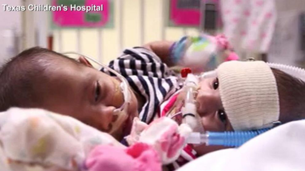 Conjoined twins opened up on what their life was like after