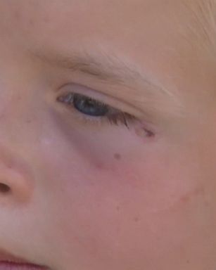 A 9-year-old Wisconsin boy reopened his lemonade stand after being shot in the face with a BB gun.