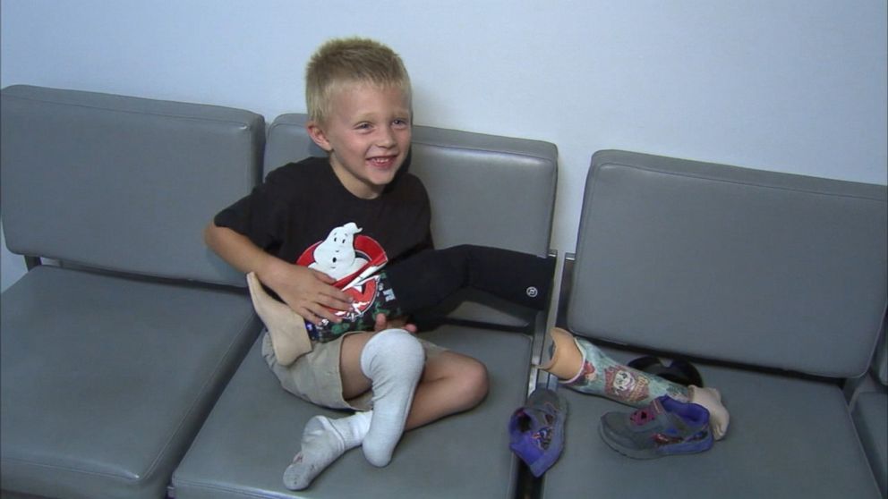 Front view of smiling female with bionic leg prosthesis sitting in