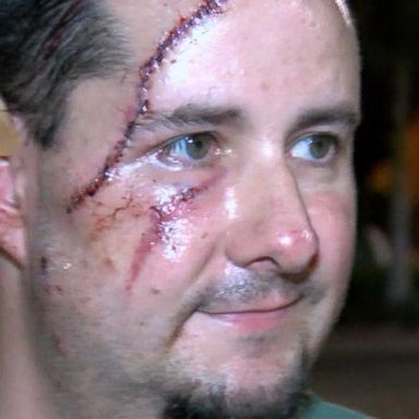 VIDEO: Florida man describes being attacked by bear