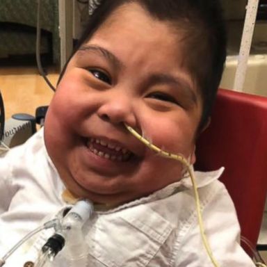 VIDEO: Jacob Rodriguez was born with his intestines, liver, and parts of his stomach outside of his body.