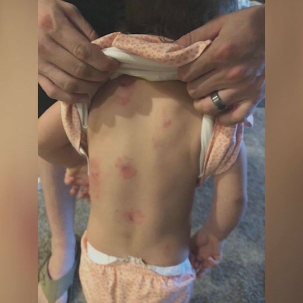 1-year-old girl bitten 'multiple times' at day care, school says - Good  Morning America