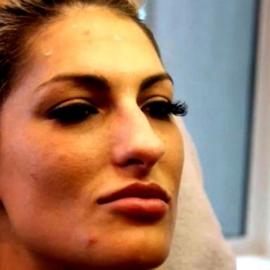 'Botox Bandit' has skipped out on payments at several medical spas: Police