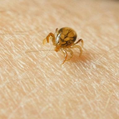 The Powassan virus, spread by deer ticks, currently has no vaccines to prevent nor medicines to treat the disease.