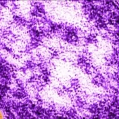 New York Mayor Bill de Blasio health officials have declared an end to the recent measles outbreak in the city in a statement released Tuesday.