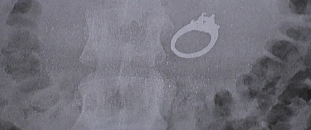 Woman Who Dreamed She Ate Her Engagement Ring Has Surgery After She Actually Did