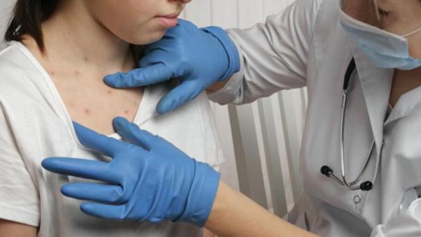 Measles cases in the US approach 30-year high