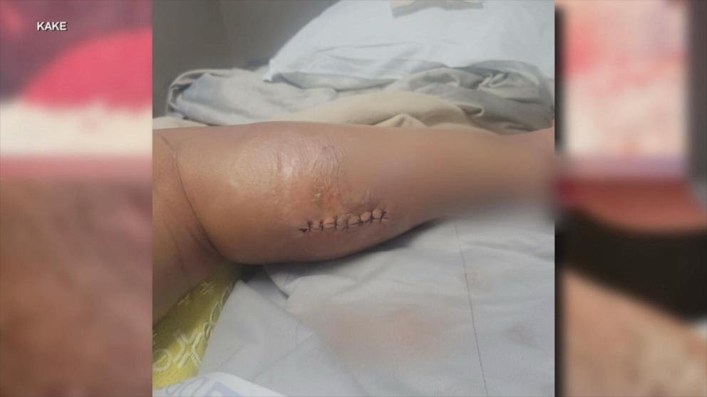 A Kansas mother of four says was left fighting for her life after suffering multiple spider bites while enjoying a campfire with her family at a local lake.