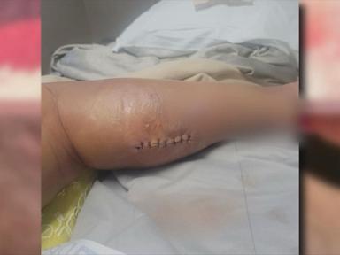 WATCH:  Mom says she was given days to live after spider-bite nightmare