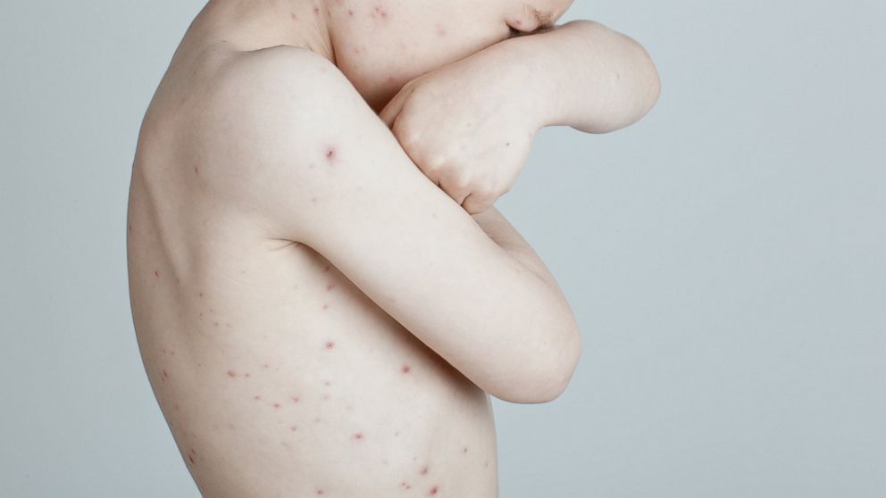 Chicken Pox Outbreak Has Infected 75 Children So Far In Orthodox