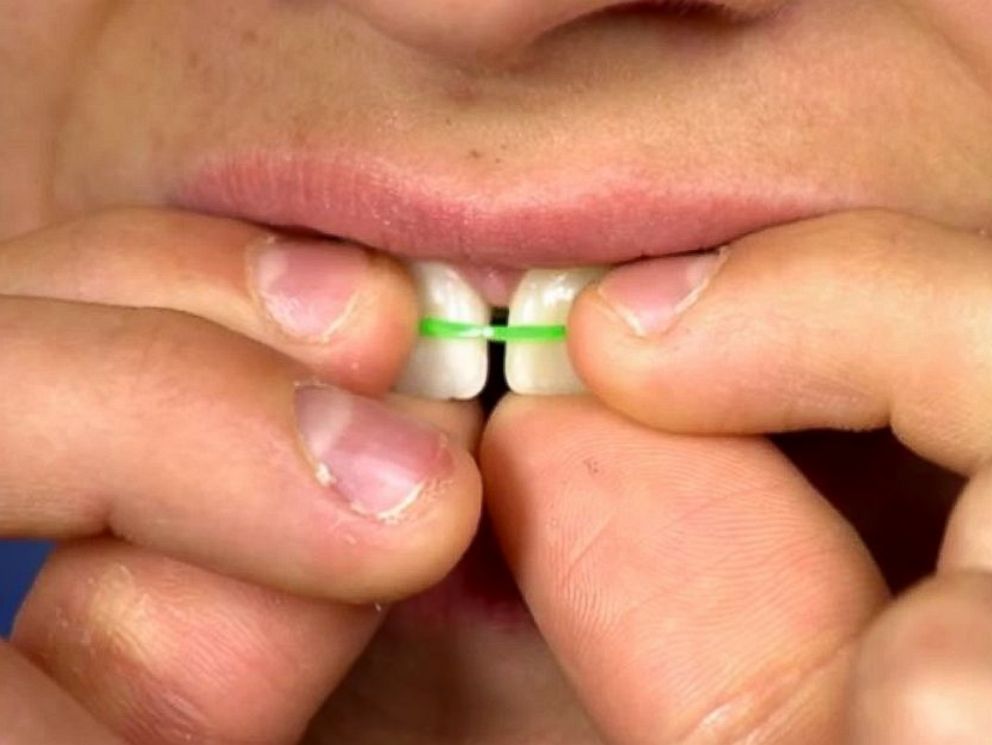 teeth straightening bands