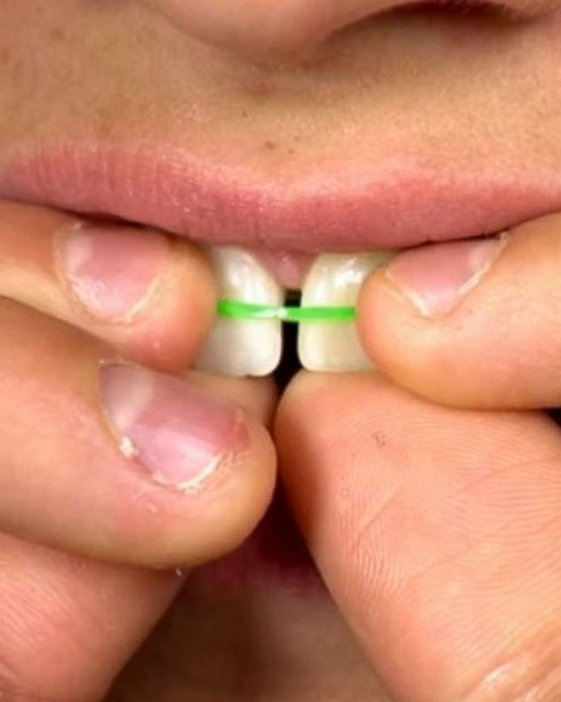 rubber band to close teeth gap