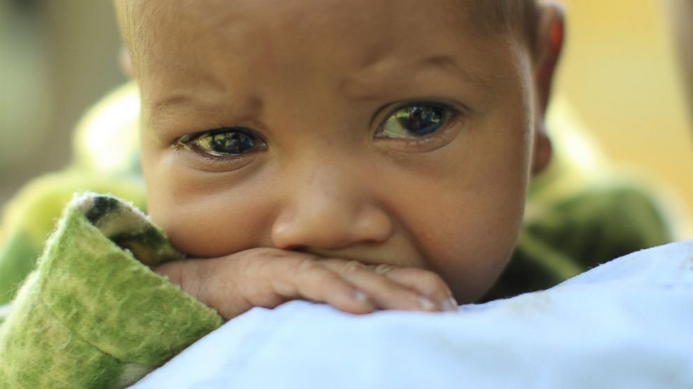 Baby Abinet is just three-months-old and he has pneumonia. A healthy adult will breathe about twelve times in a minute. A child with pneumonia will take at least sixty short, painful gasps. Pneumonia kills more children than AIDS, malaria and tuberculosis combined every year. 